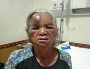 Mobil Box Indomaret Hantam Betor, Nenek Dirawat di RSUD Adam Malik
